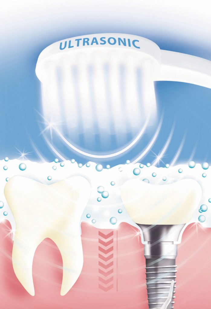 emmi zahn implantat